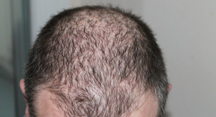 En hårtransplantation är ofta en oslagbar åtgärd mot oönskat håravfall