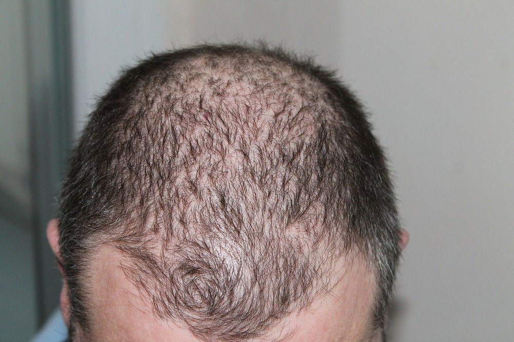 En hårtransplantation är ofta en oslagbar åtgärd mot oönskat håravfall